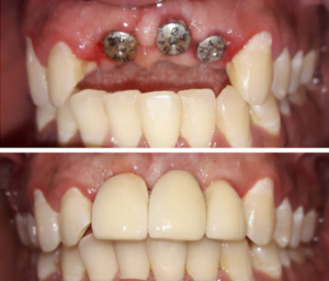 Dental implant in Dhaka Bangladesh