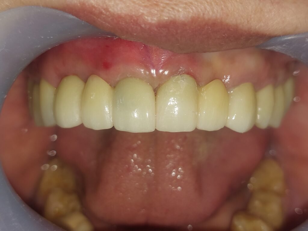 Immediate implant