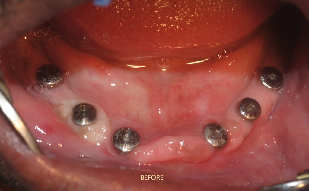 Full jaw implant- Dr. uttom