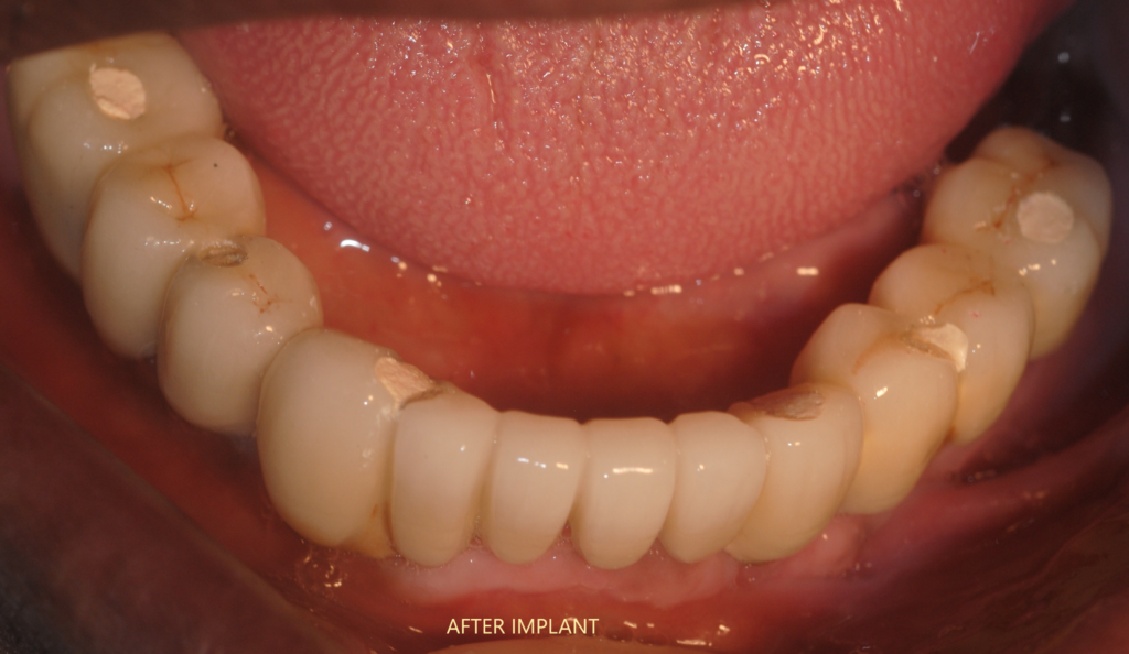 full-jaw-implant-dr.-uttom