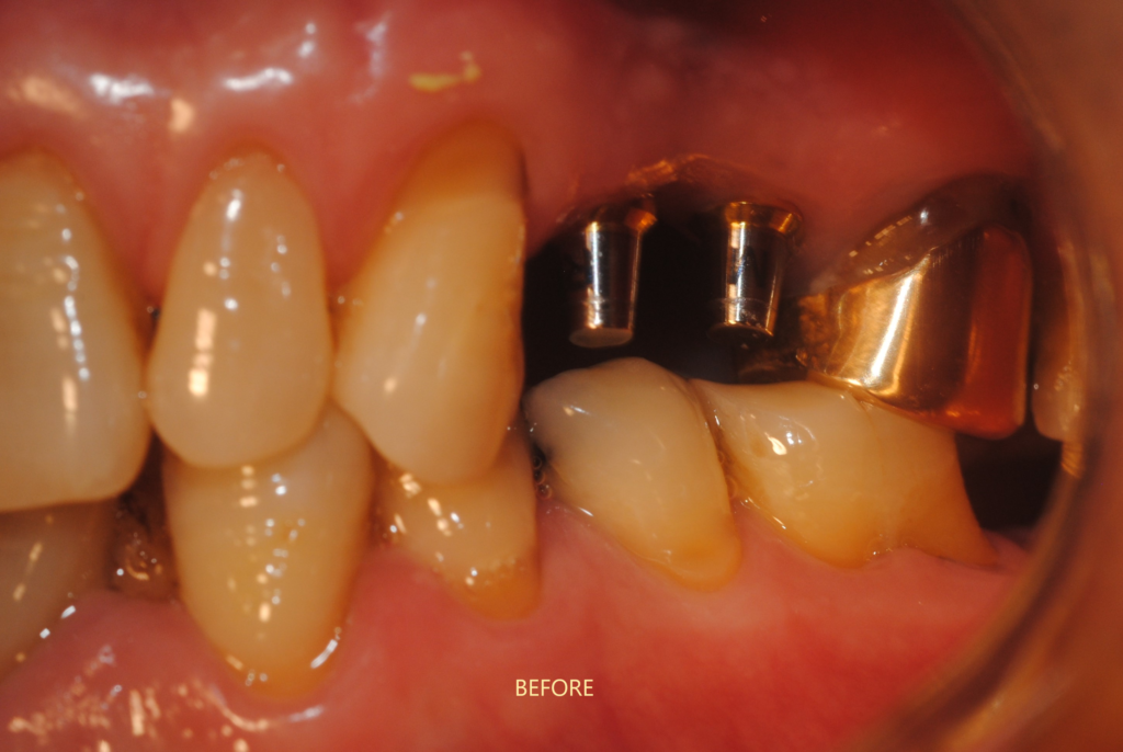 implant dentist dhaka