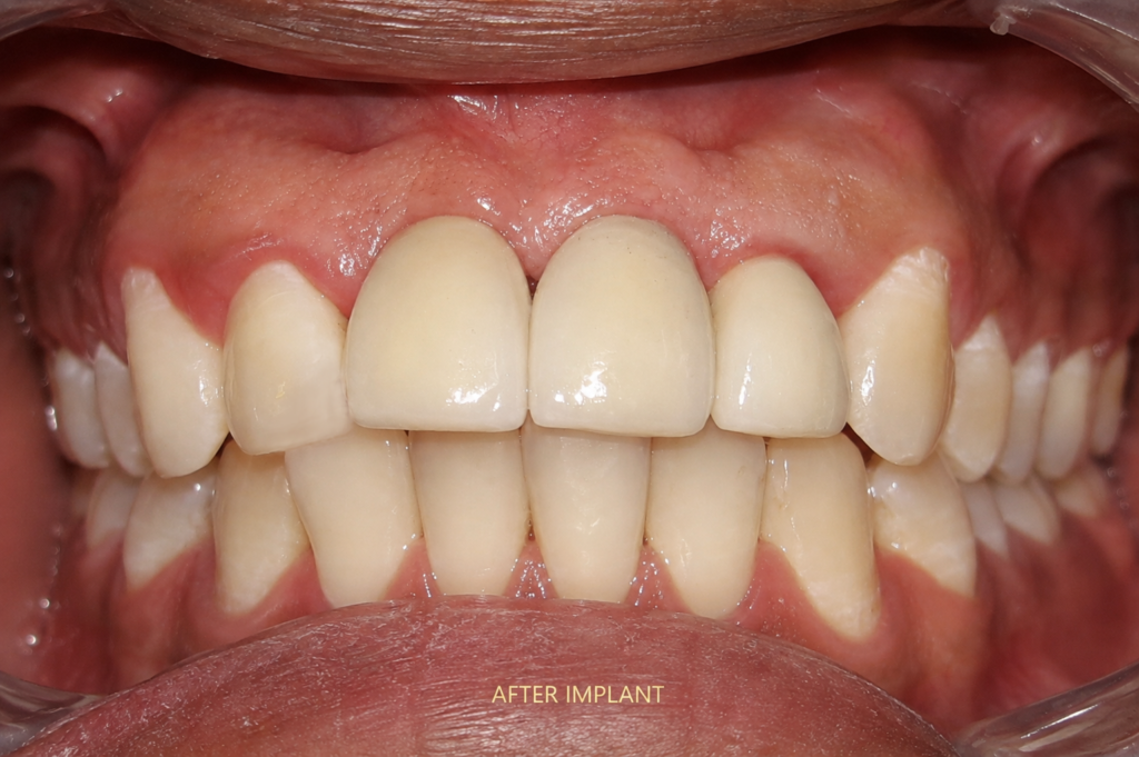 immediate implant after accident