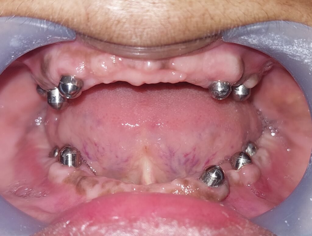 best-implant-clinic-dhaka