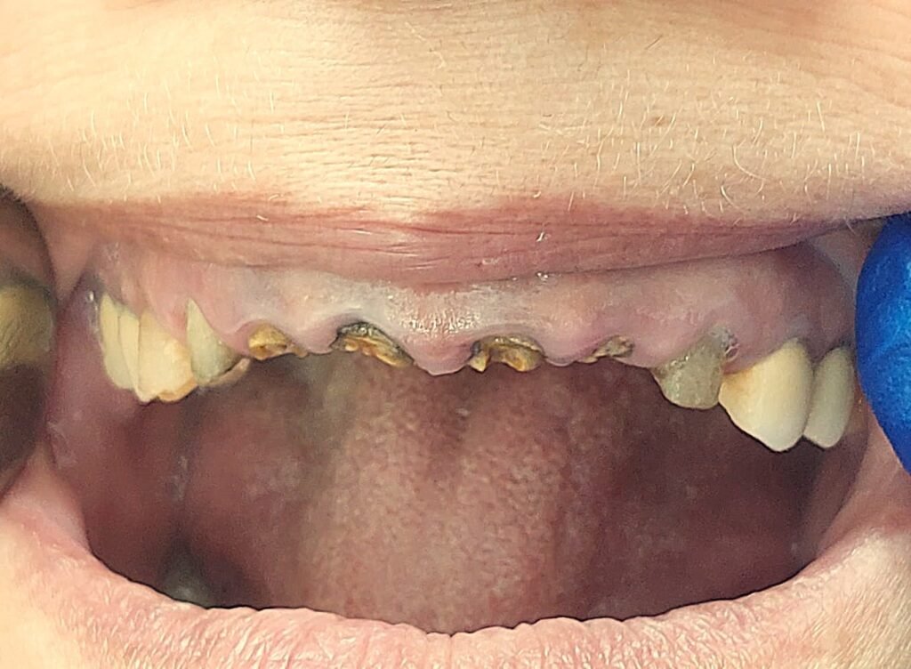 Immediate hiossen implant