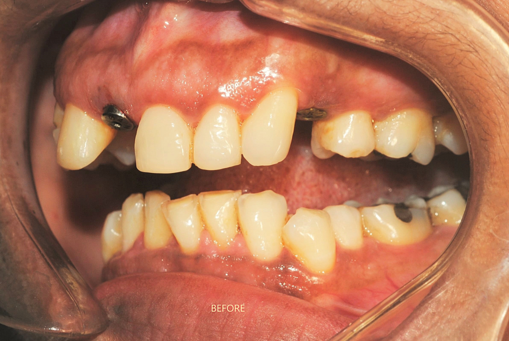best implant doctor-dr-uttom