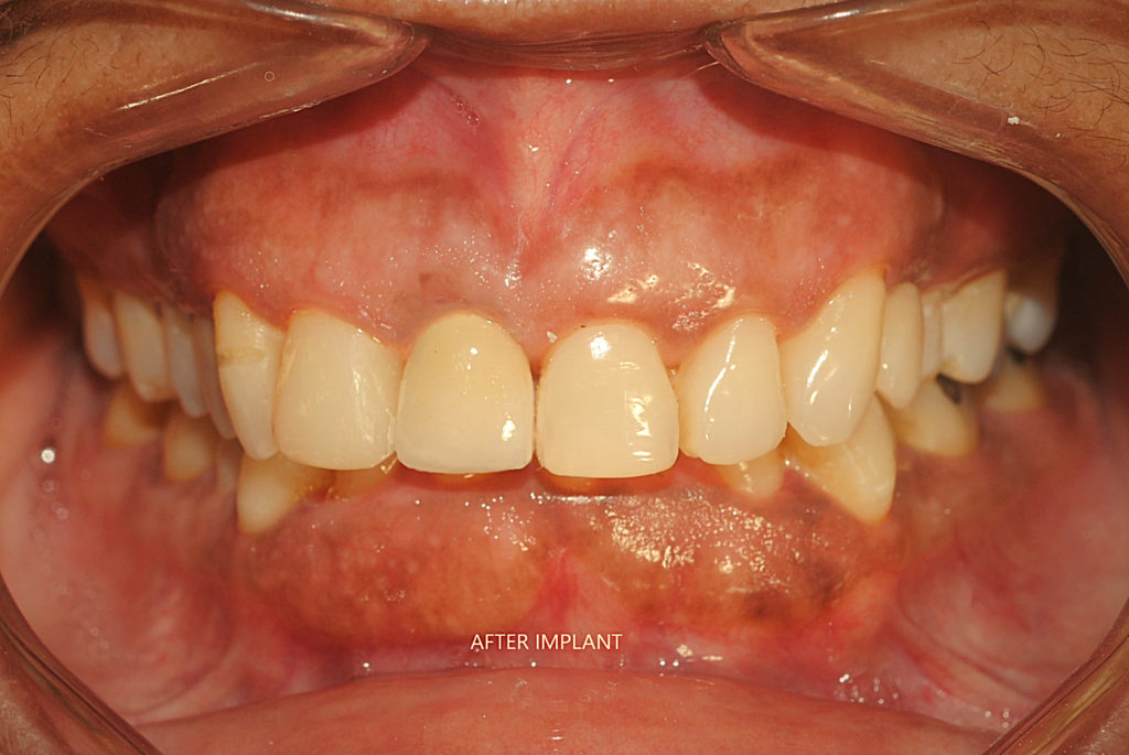 best implant-dr. uttom
