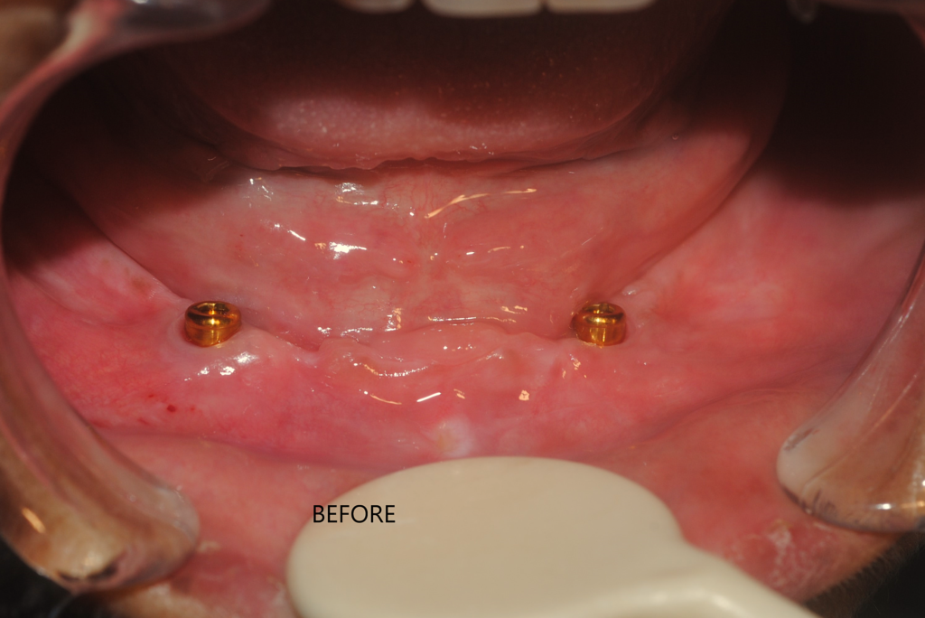 implant-denture-dr-uttom