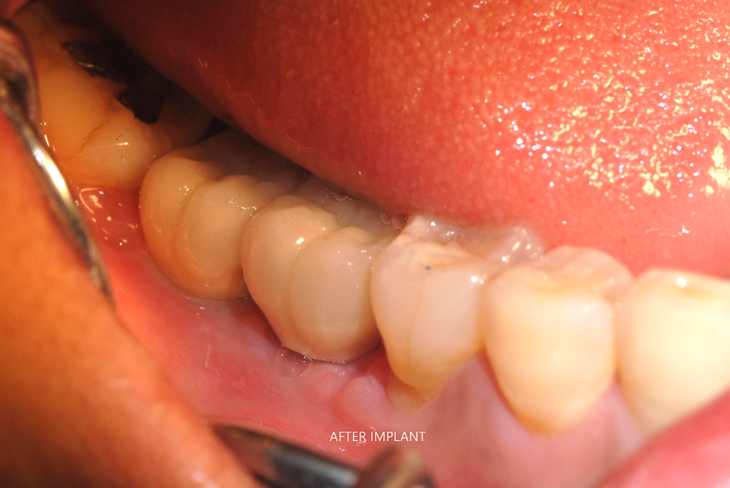 implant clinic dhaka