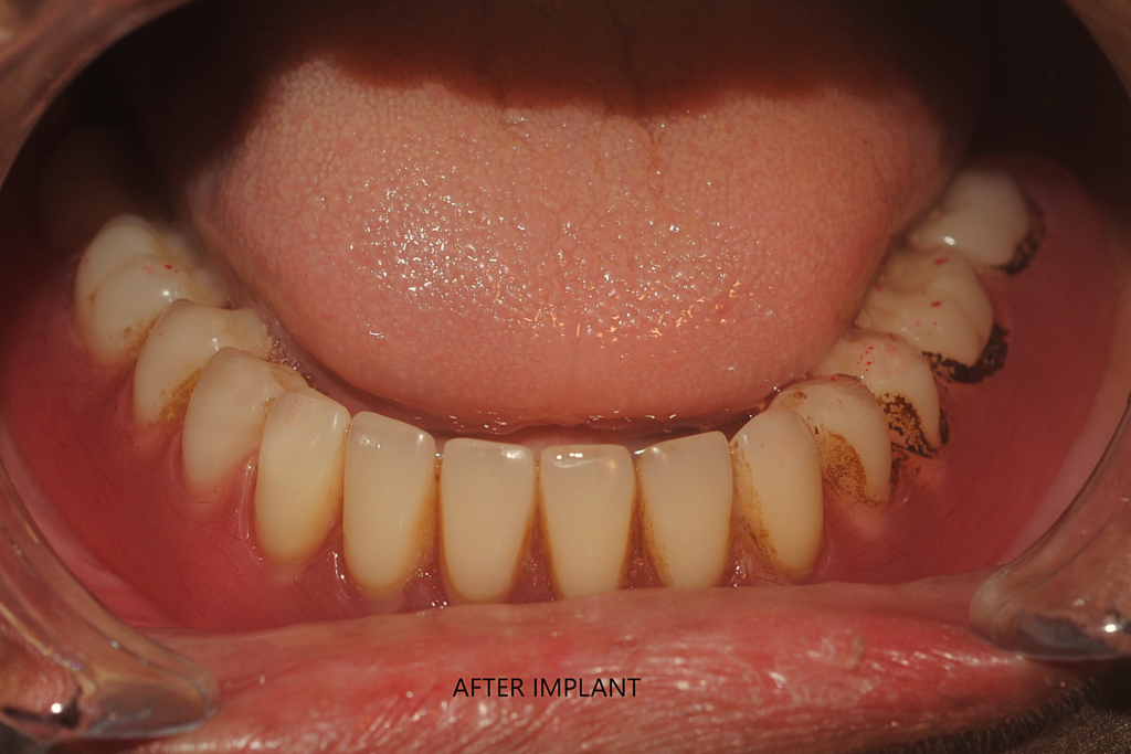 implant-denture-dr-uttom