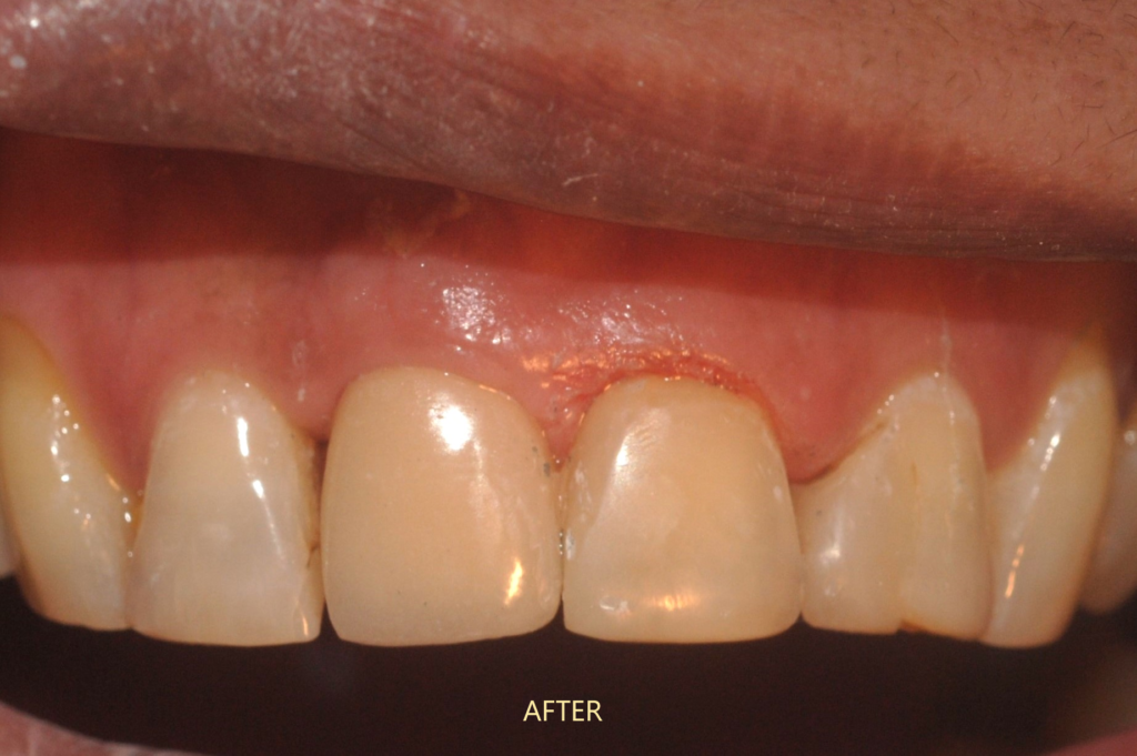 implant-dhaka-dental-excellence