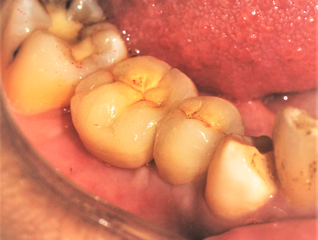 implant-dhaka-dr-uttom