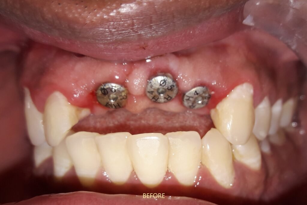 immediate implant after accident
