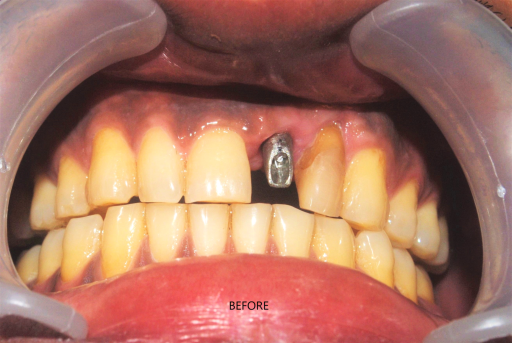 implant -uttara