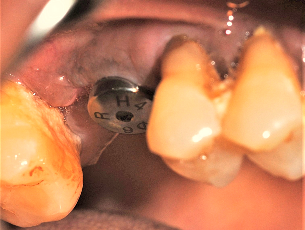 osstem-implant-dr-uttom