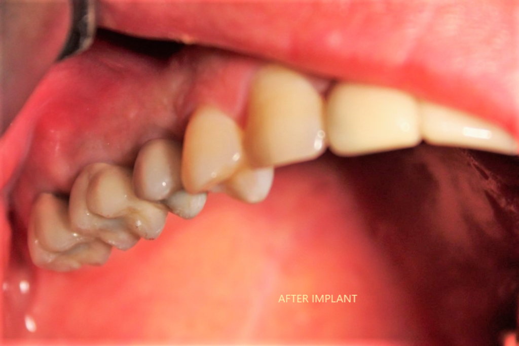 osstem-implant-dr-uttom