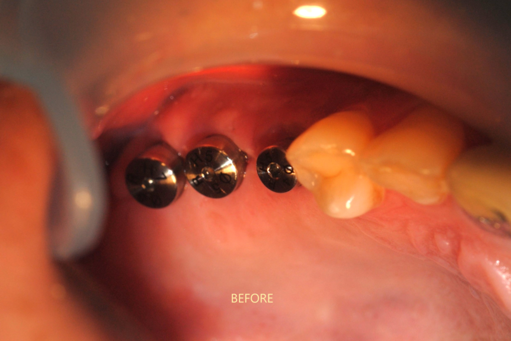 osstem-implant-dr-uttom