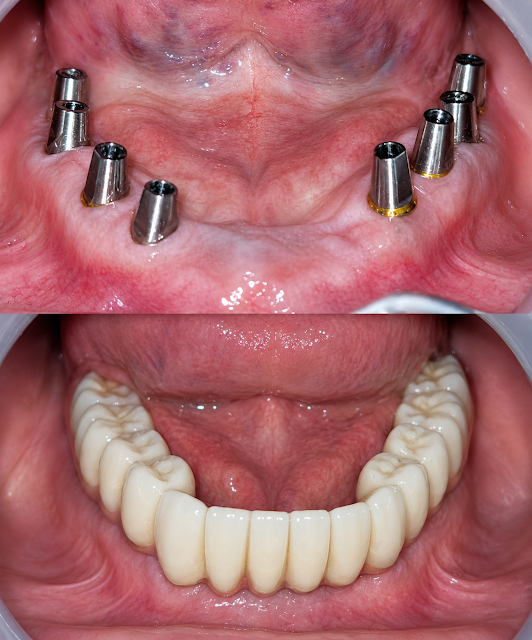 implant clinic dhaka