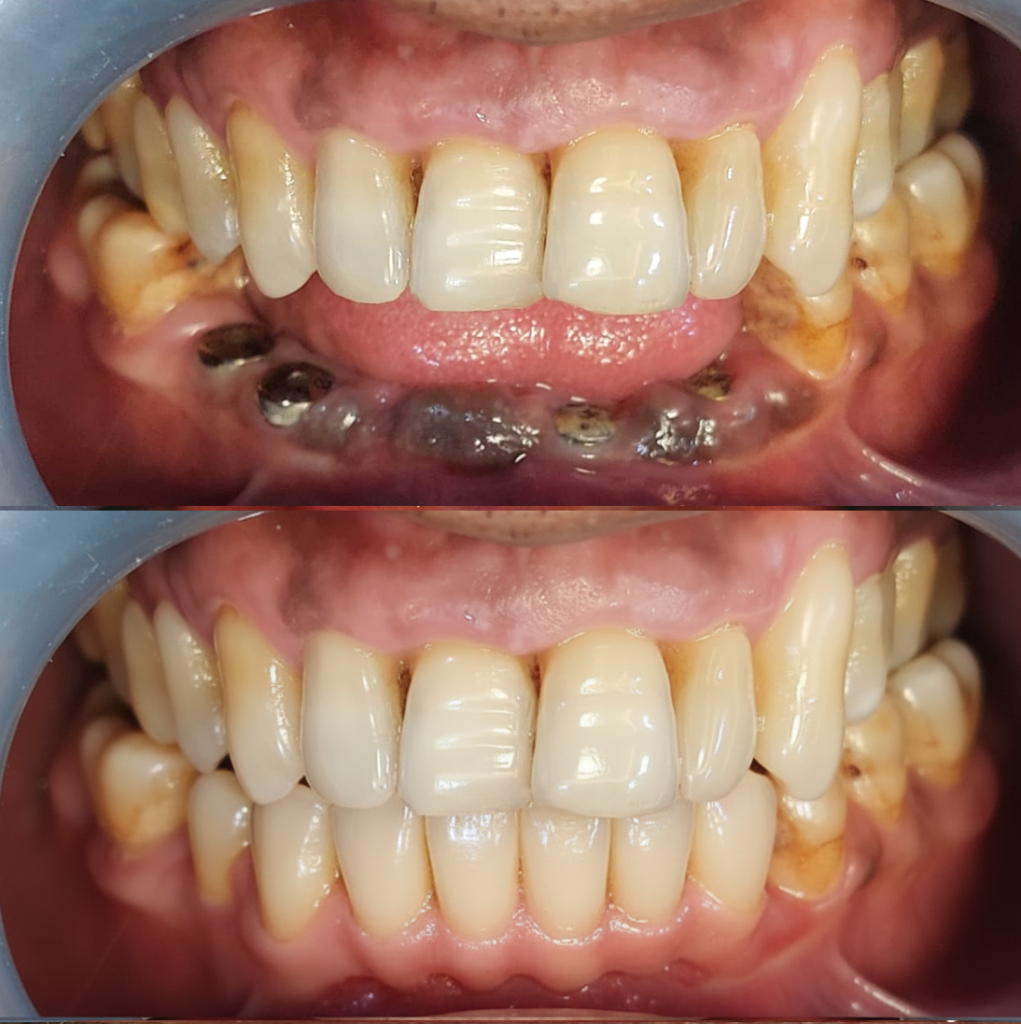 dental implant clinic uttara