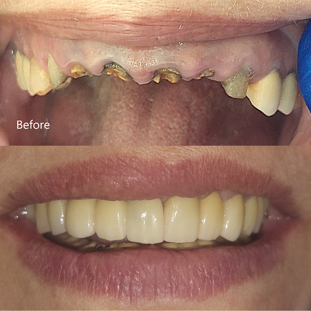 implant treatment