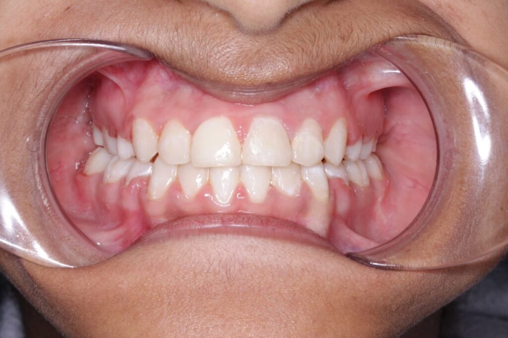 braces treatment uttara
