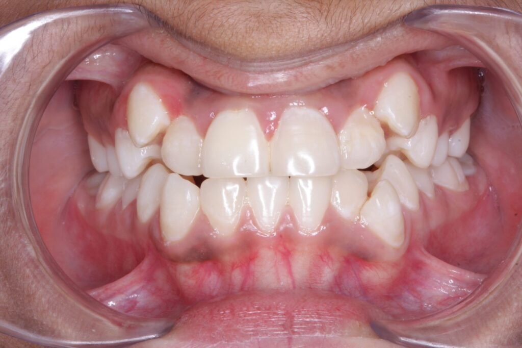 braces treatment uttara