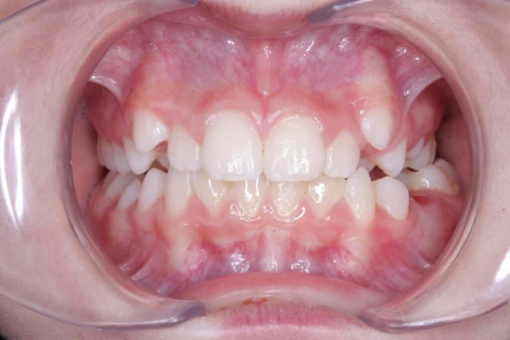 braces treatment