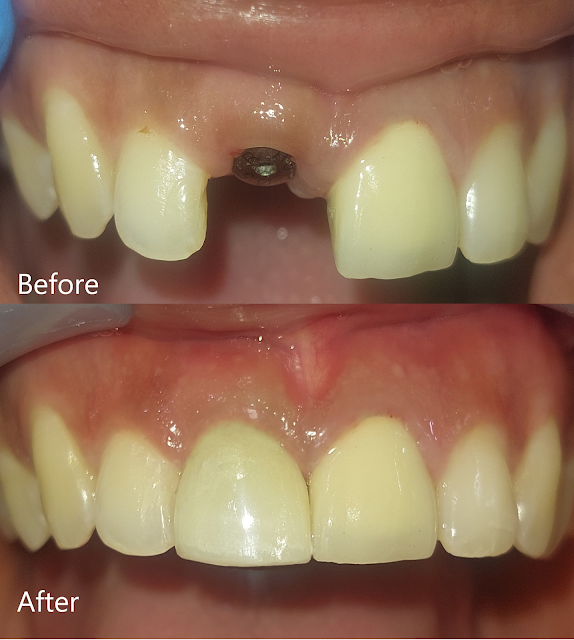 osstem implant