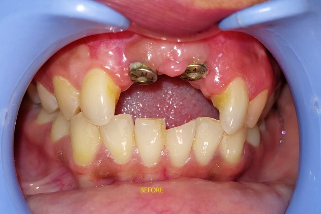 front tooth implant