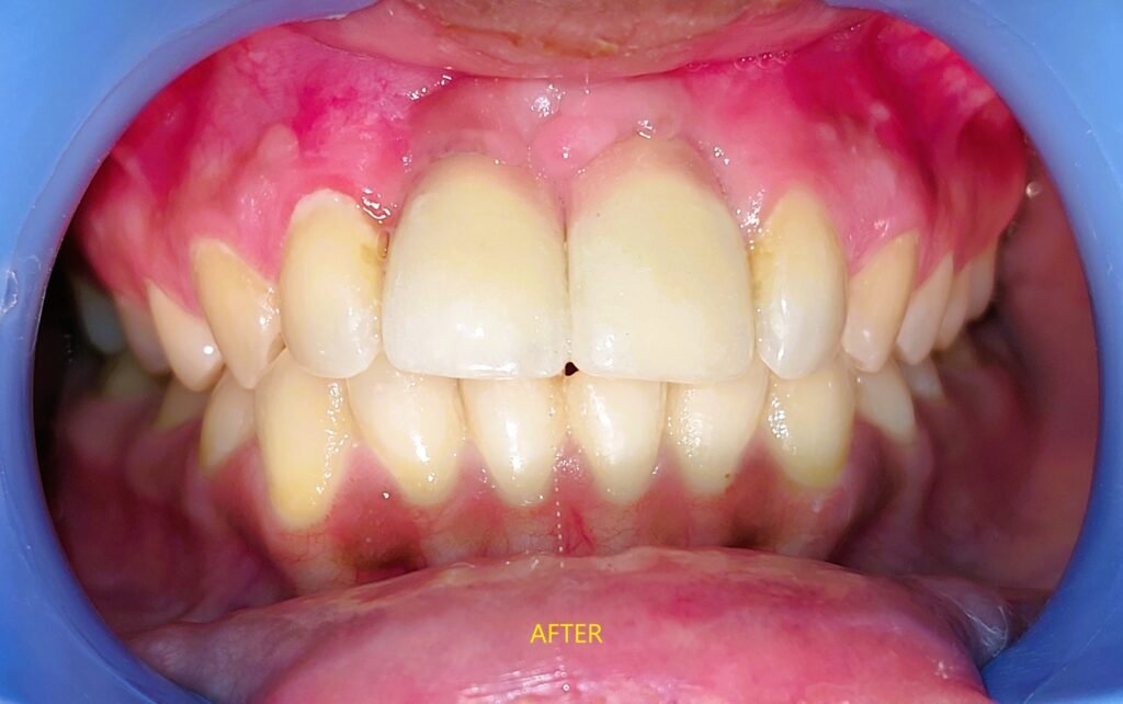 front tooth implant