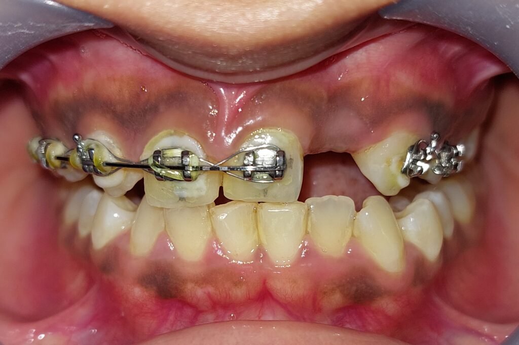 orthodontics and implant