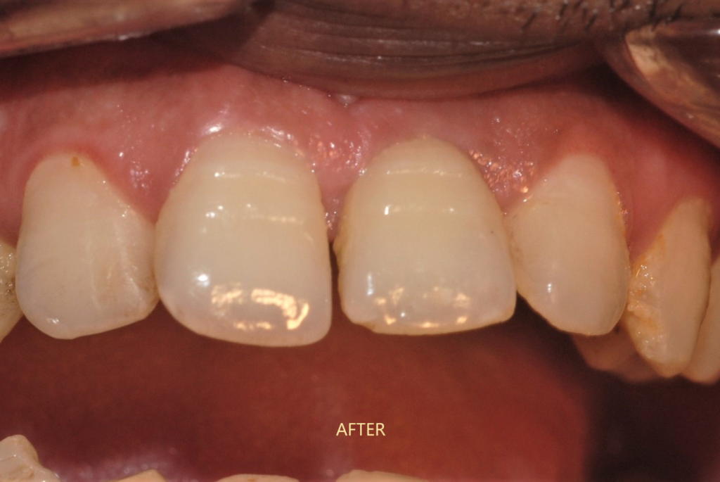 implant anterior tooth