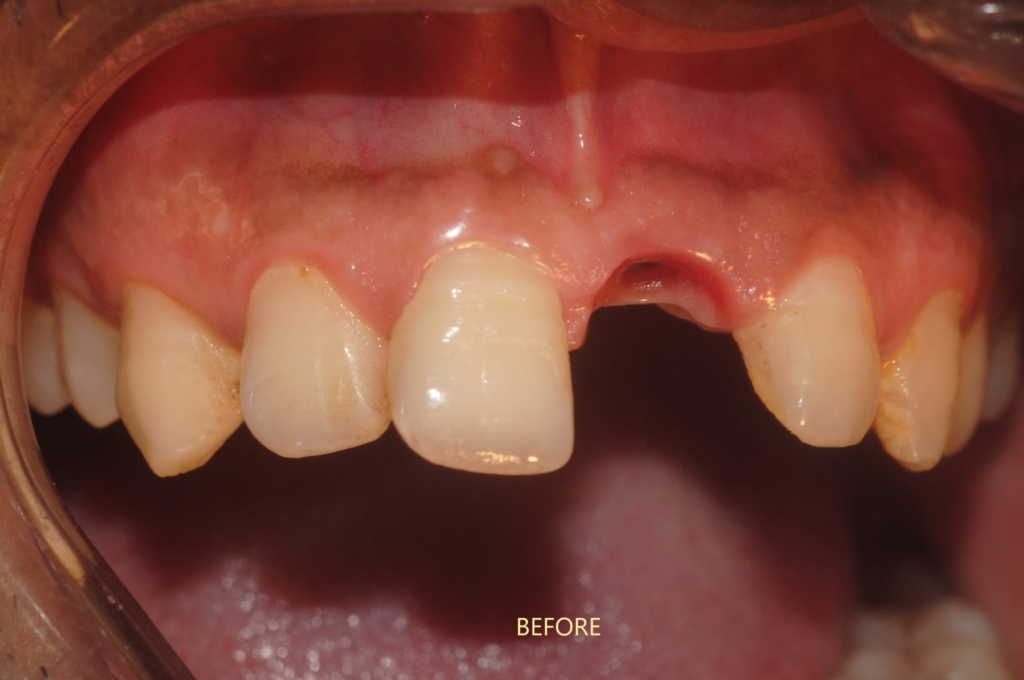implant anterior tooth