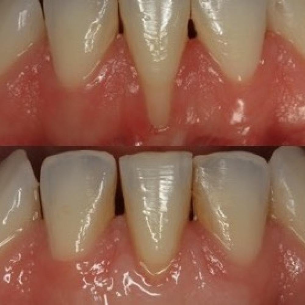 gum grafting