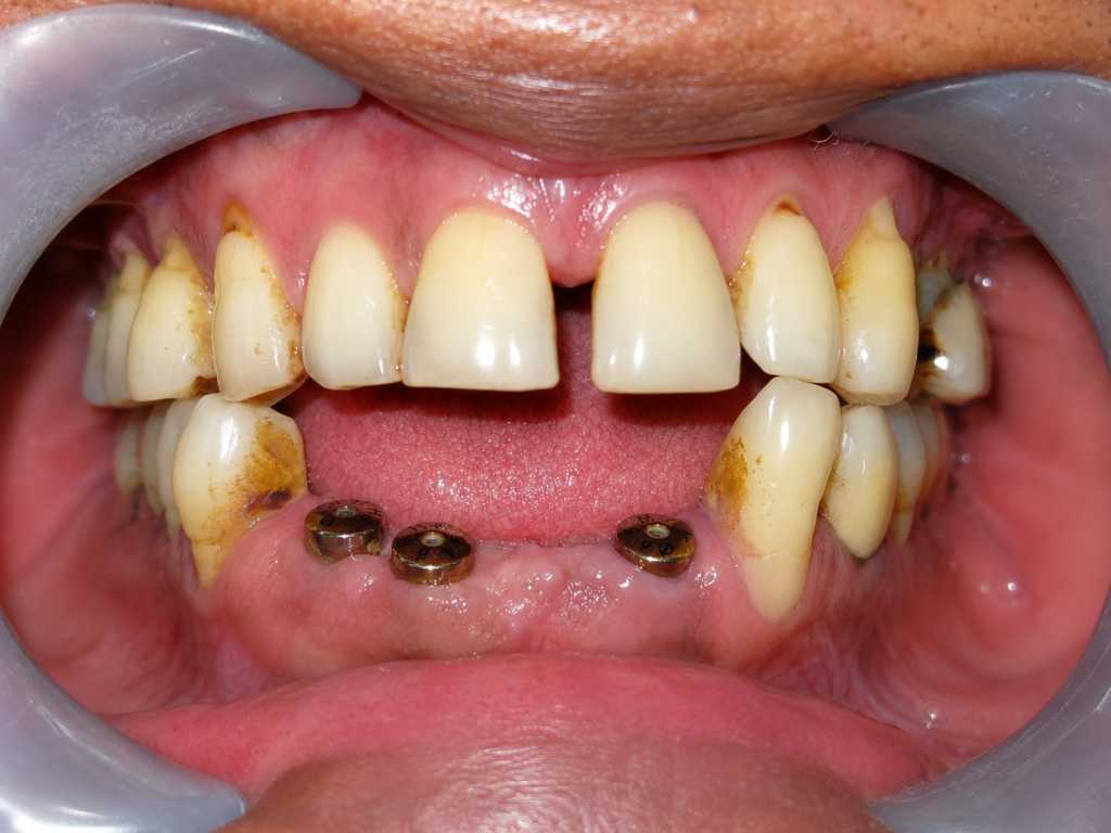 implant-doctor-dr.-uttom