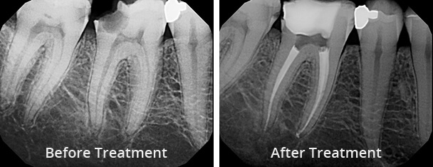 root canal