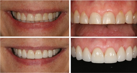 full mouth zirconium