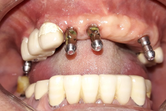 best implant clinic dhaka