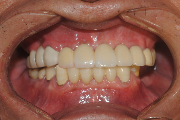 best implant clinic dhaka