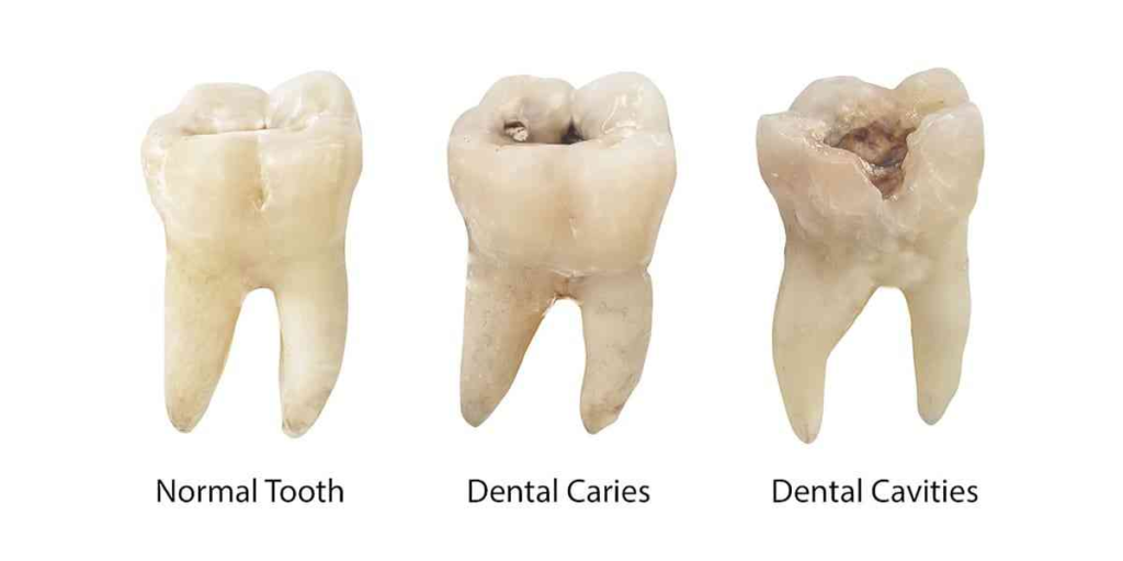 Dental filling