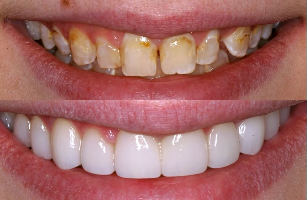 zirconium crown