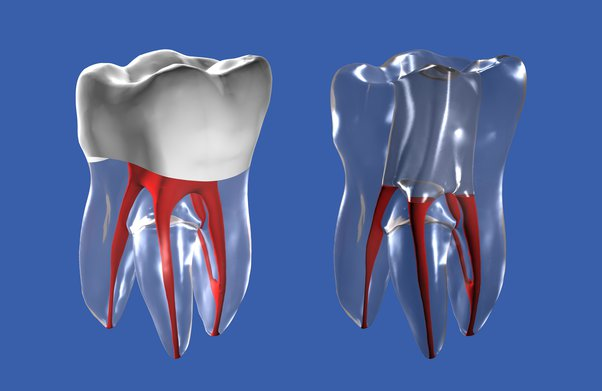 Root canal