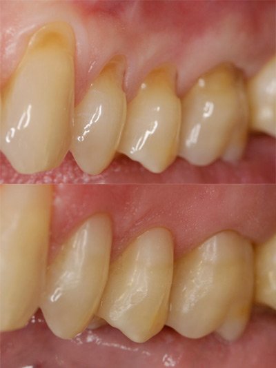 tooth abrasion