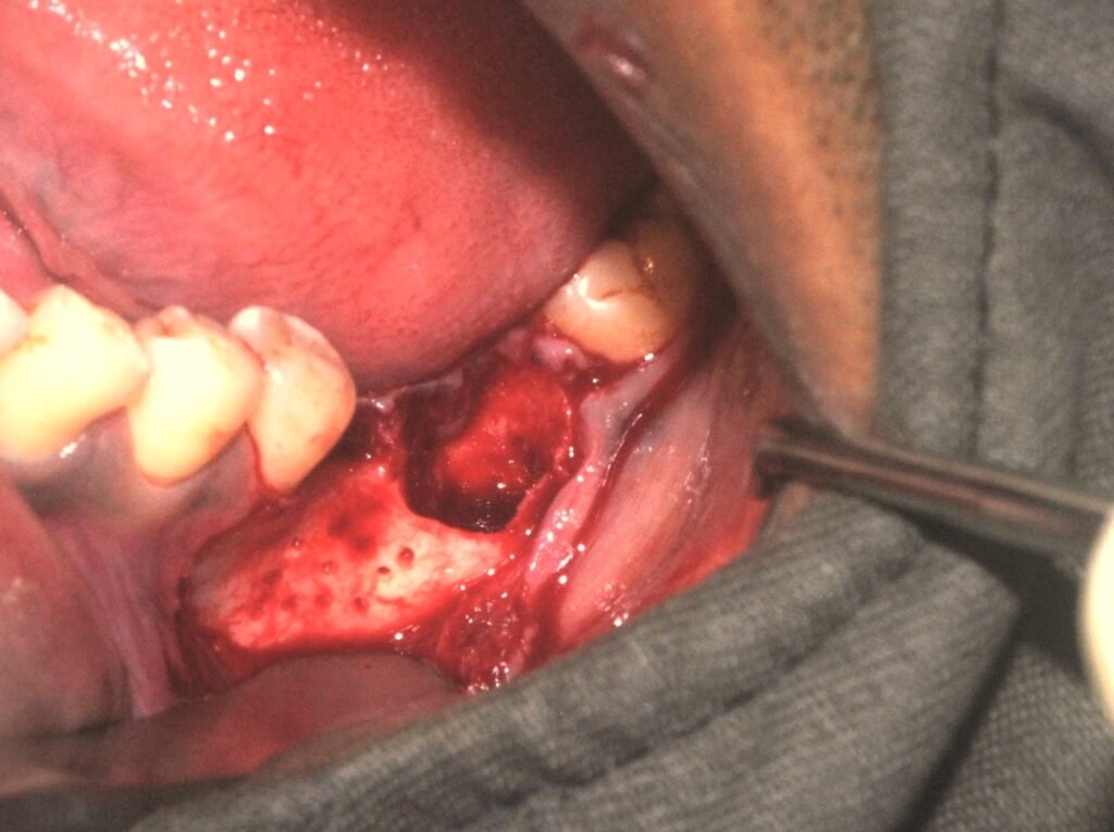 bone graft by dr. uttom