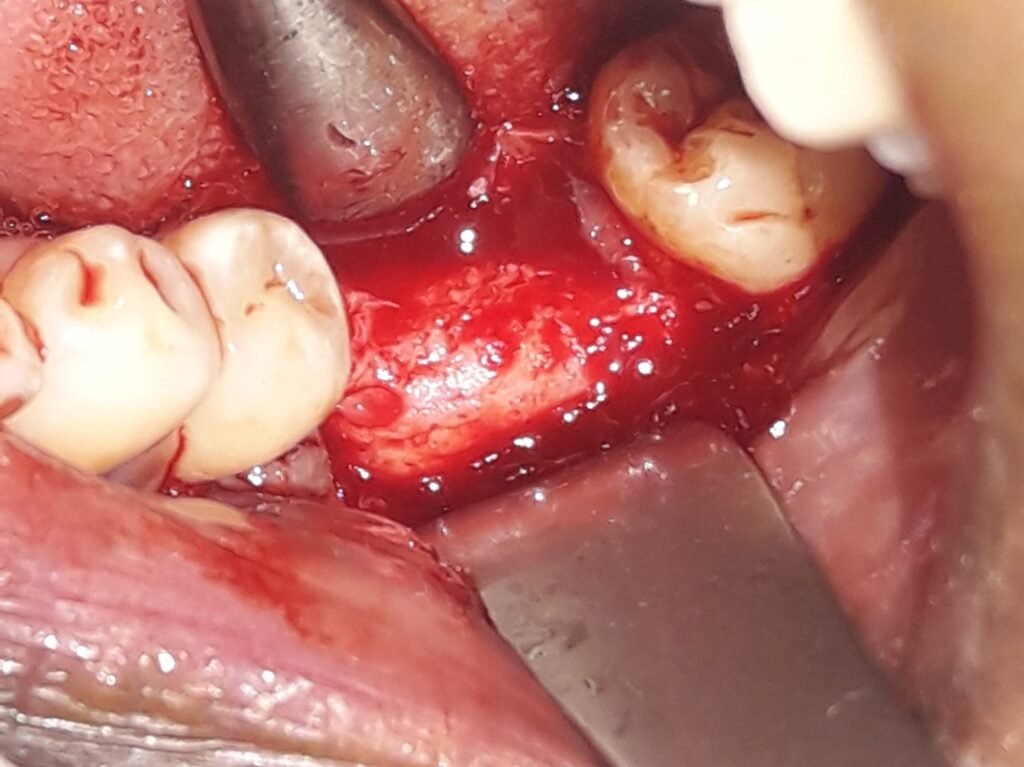 bone graft dr. uttom