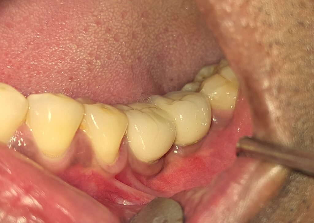 bone graft dr. uttom