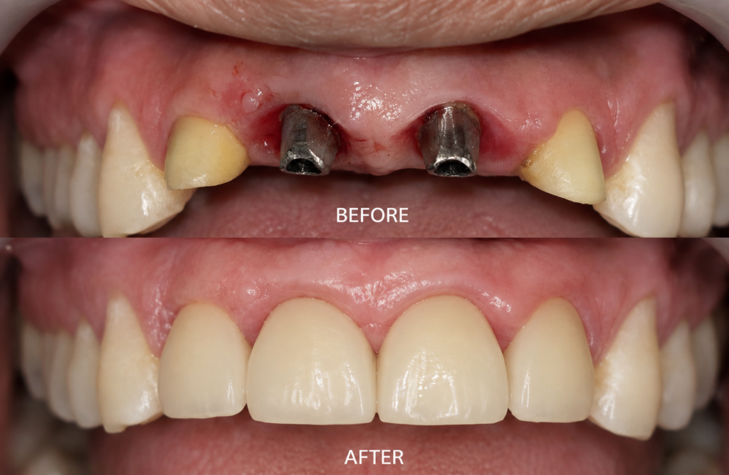 implant for accidental teeth loss