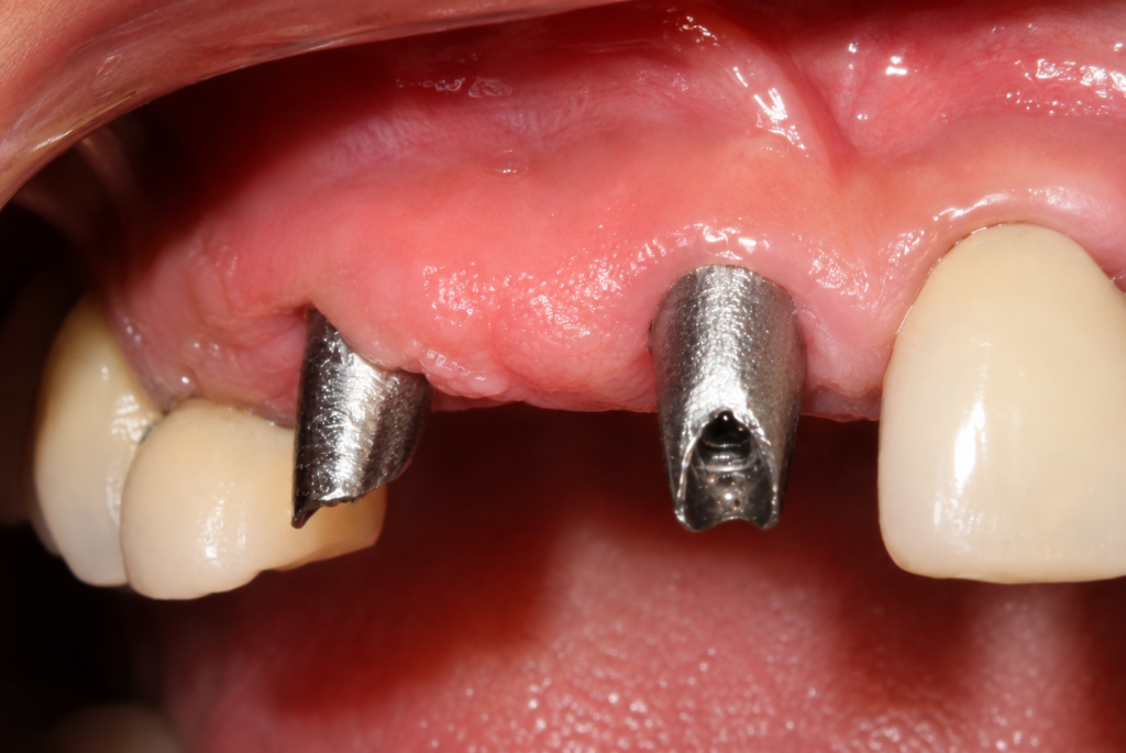 implant-uttara-dr. uttom