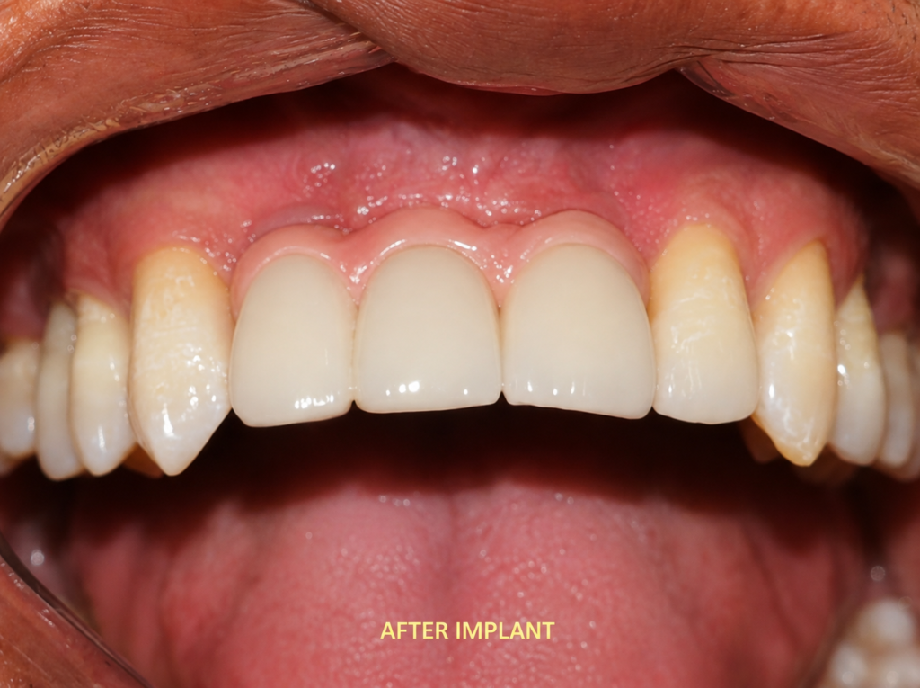 osstem implant - dr. uttom