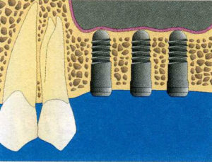 sinus bone graft dr. uttom
