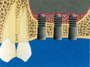 sinus bone graft dr. uttom